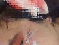 Ibu Rumah Tangga di Tanggamus Disayat Pisau Suami Siri, Luka Parah di Kepala dan Bahu